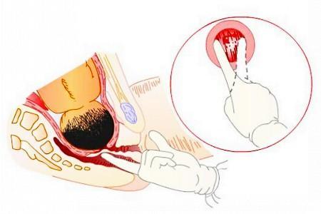 分娩时，“开五指”“开七指”到底是什么意思？