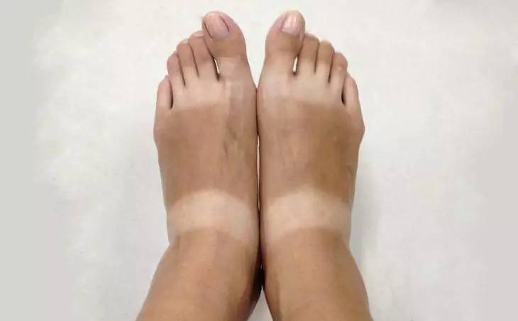 脚上穿凉鞋晒出印怎么去除,脚上有凉鞋印怎么去除