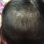 大额头适合用什么植发,大额头发际线高怎么办