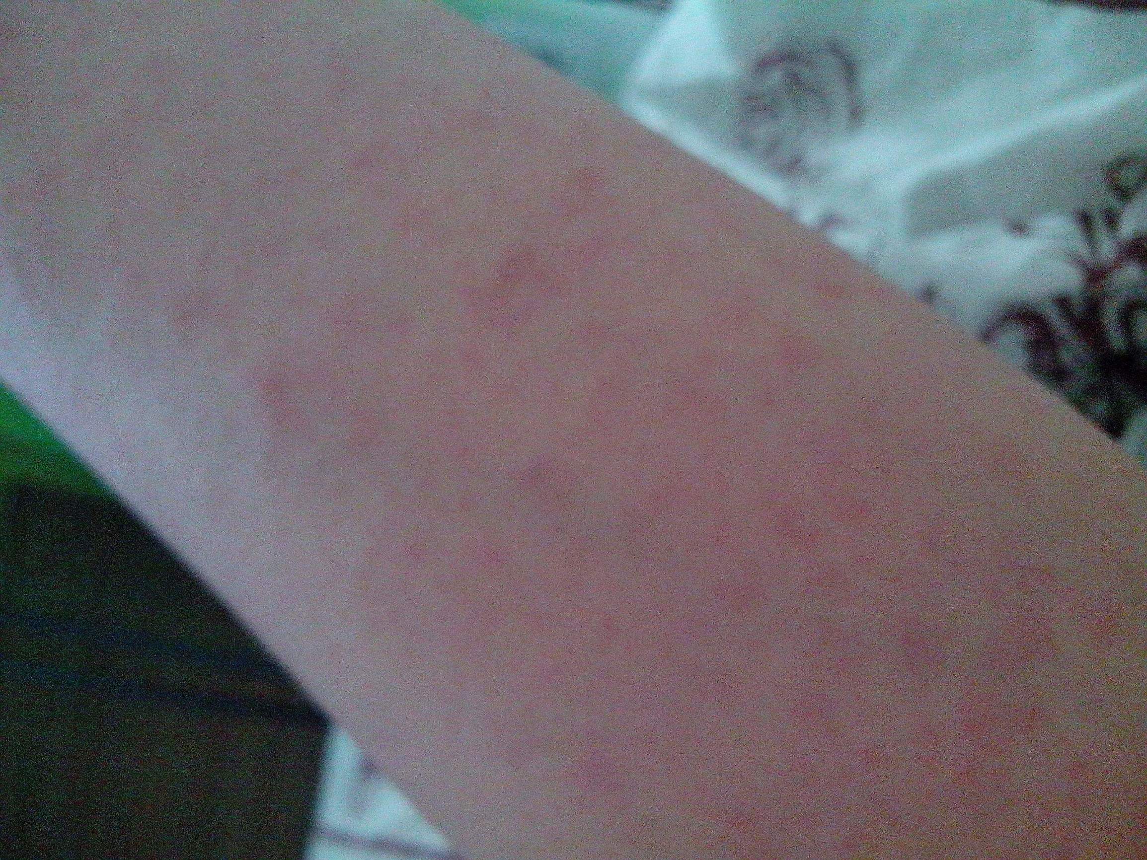 手臂上长了小红点不痛不痒像痣,出现小红痣不痛不痒