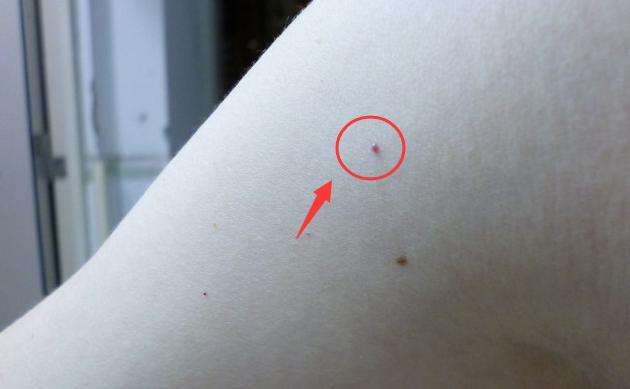 手臂上长了小红点不痛不痒像痣,出现小红痣不痛不痒