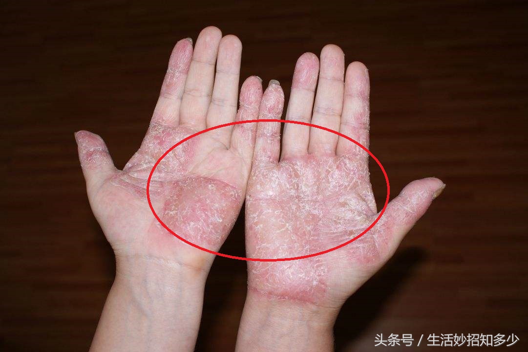 手脚脱皮有什么特效药吗,手脚脱皮怎么不用药