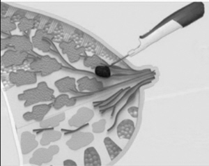 102种疑难杂症解决乳腺增生,乳腺囊性增生和乳腺囊肿有区别吗