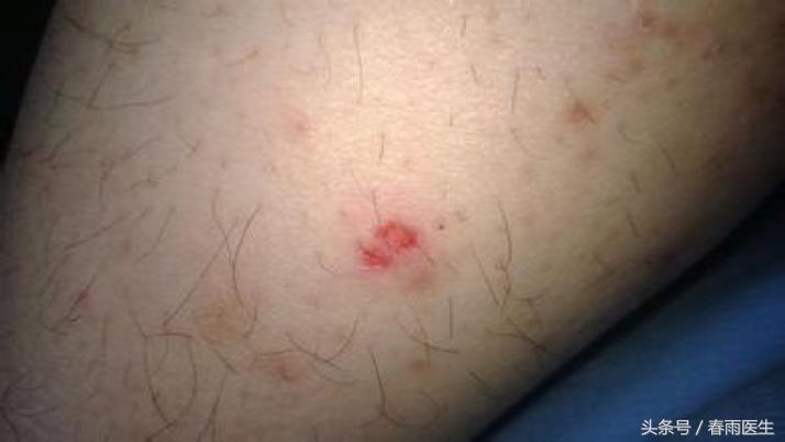 被人咬了，除了让TA赔钱，你还必须这么做！