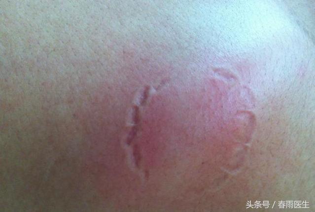 被人咬了，除了让TA赔钱，你还必须这么做！