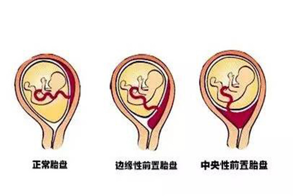 前壁胎盘是不是比较难感觉胎动,前壁胎盘如何变成完全性前置胎盘