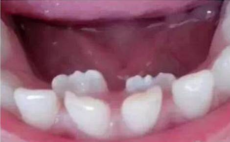 宝宝换牙期间不爱喝奶,换牙乳牙一直不松不掉咋办