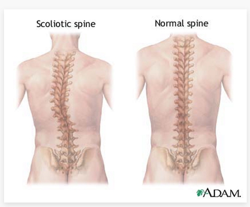 康睿仕脊柱弯曲矫正方法,康睿仕的脊柱侧弯