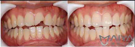 深圳麦芽口腔种牙靠谱吗,深圳麦芽口腔根管治疗多少钱