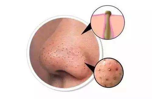 收毛孔去黑头的有效的方法,收毛孔去黑头的有效的小妙招