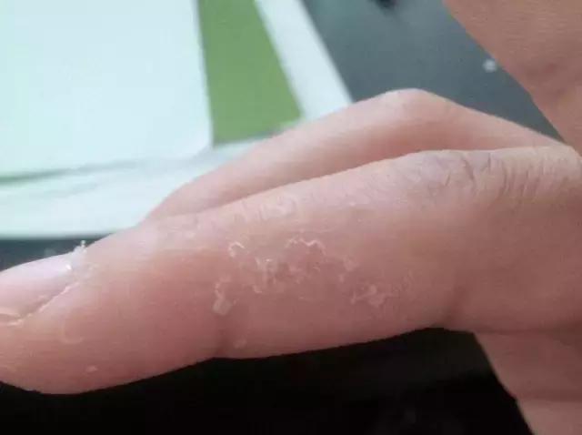 孩子身上反反复复起湿疹怎么回事,婴儿湿疹反反复复怎么治彻底