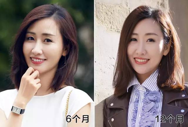 整牙戴的粉色的牙套,整牙给人带来的变化