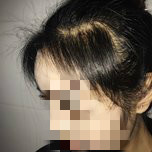 大额头适合用什么植发,大额头发际线高怎么办