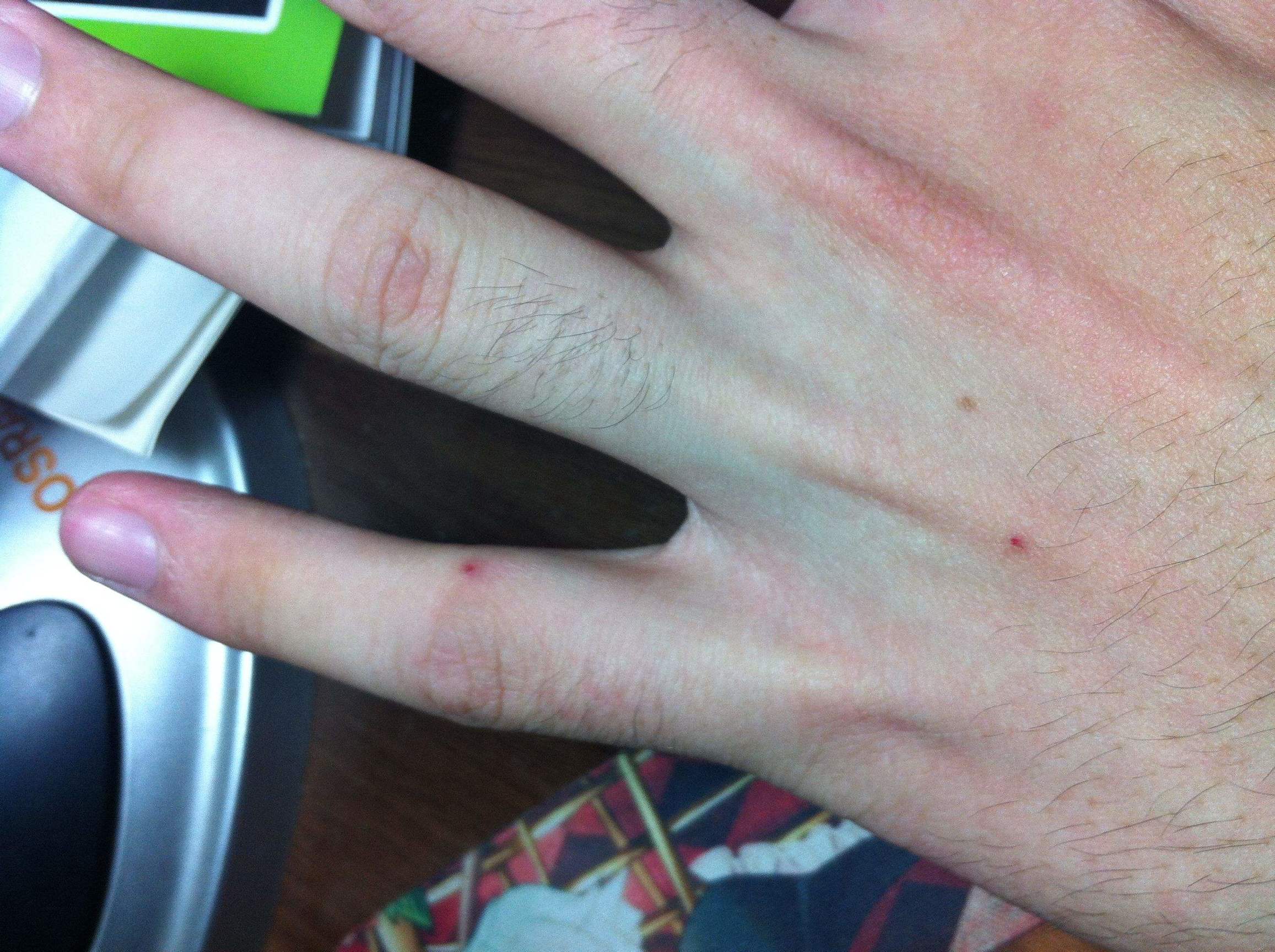 手臂上长了小红点不痛不痒像痣,出现小红痣不痛不痒