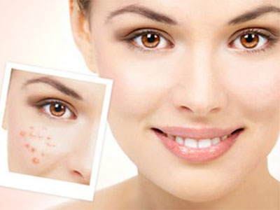 消除痘痘和痘印最简单的方法,很严重的痘痘痘印怎么消