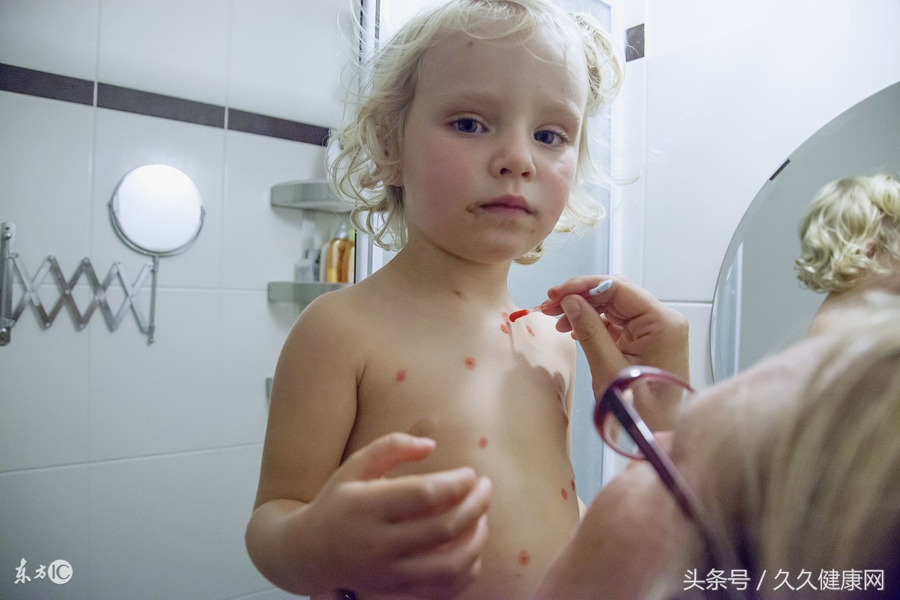儿童患水痘怎么办,孩子得水痘怎么护理