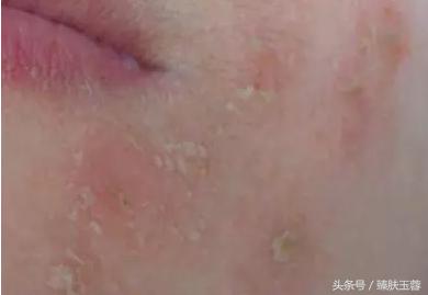 化妆品引起的过敏性皮炎,化妆品皮炎的症状图片