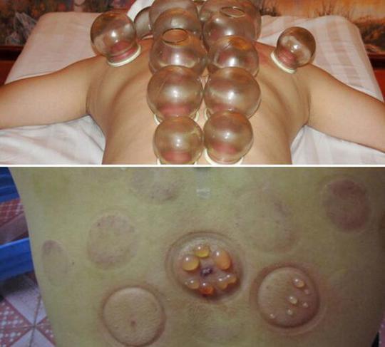 拔火罐出水泡是体内湿气重吗,拔火罐治疗湿气重一般多久能治好