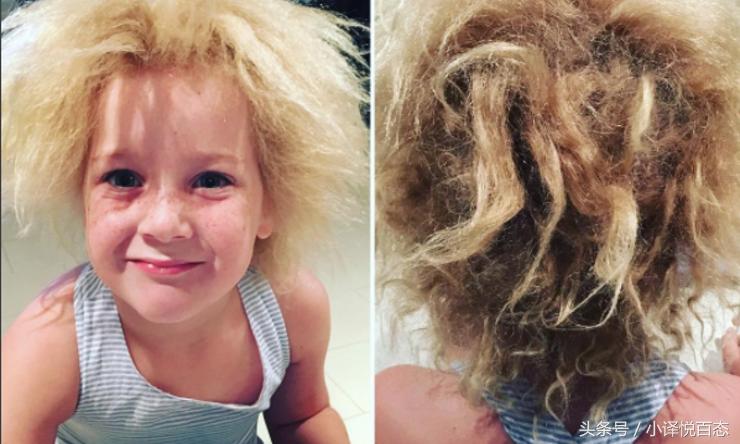 澳大利亚女性蓬发综合症,澳大利亚女孩难梳头发综合征