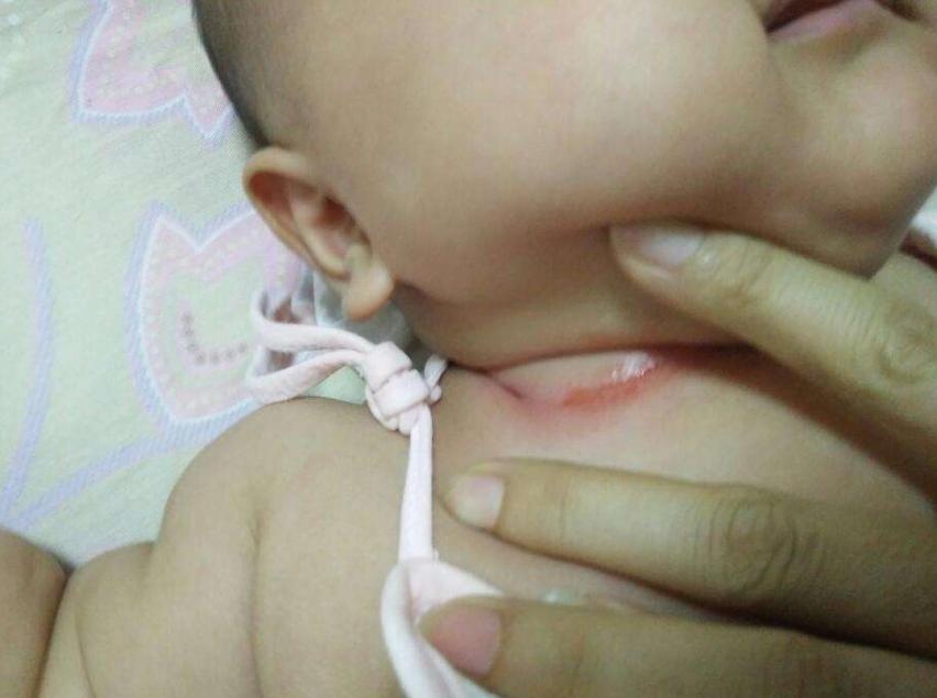 防止宝宝脖子被淹擦什么,宝宝脖子被淹为什么要用茶水洗