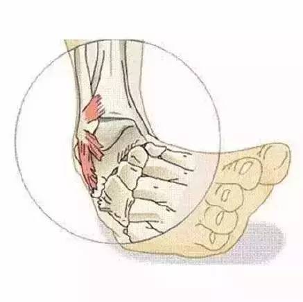 打球崴脚了怎么快速处理,打球崴脚了的正确处理流程