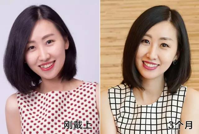 整牙戴的粉色的牙套,整牙给人带来的变化