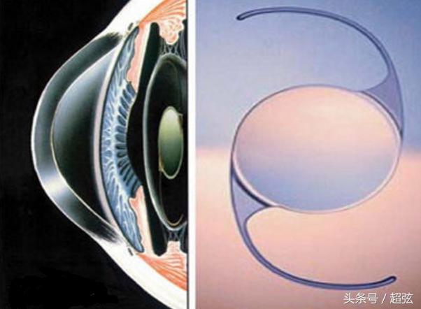 icl晶体植入最大多少度近视,icl晶体植入未来还会近视吗