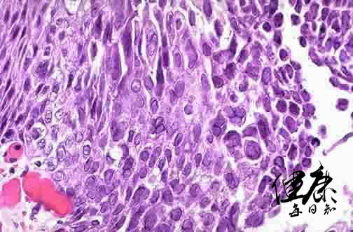 嘴巴上火起泡是病毒还是细菌,病毒性上火嘴上长泡多久能好