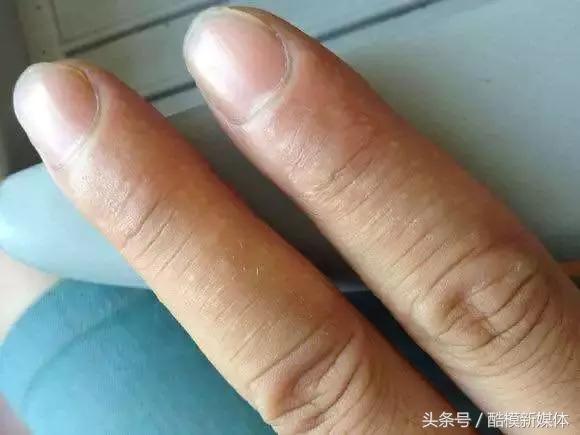 每天傍晚手上起硬疙瘩奇痒难忍,手上痒起硬疙瘩