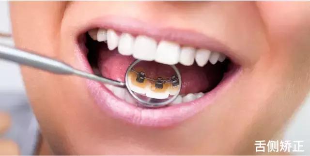 全口牙套的种类和价格,矫正牙套种类及价格表