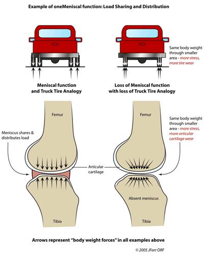 半月板的损伤怎么治疗,膝关节半月板损伤类型和缓解方法