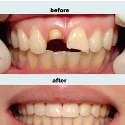 深圳麦芽口腔种牙靠谱吗,深圳麦芽口腔根管治疗多少钱