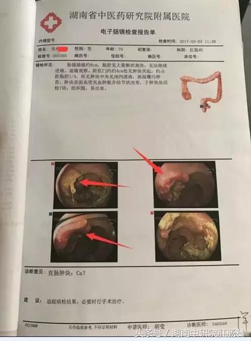 低位直肠癌冷冻治疗,直肠癌冷冻