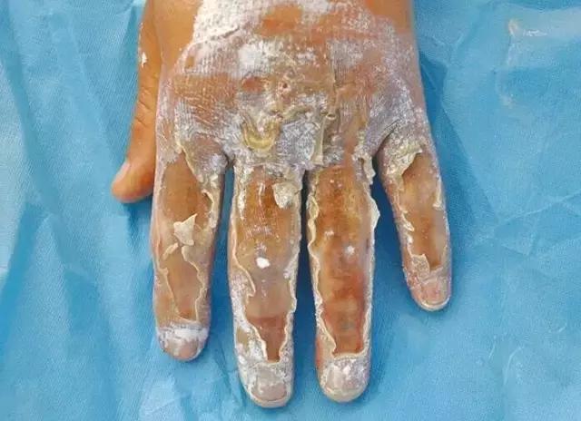 vsd负压引流加皮瓣移植,vsd植皮和皮瓣手术哪个损伤大