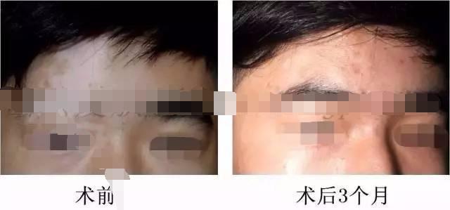白癜风表皮移植能达到完全恢复吗,白癜风自体黑色素移植效果怎么样