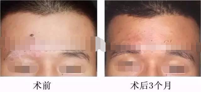 白癜风表皮移植能达到完全恢复吗,白癜风自体黑色素移植效果怎么样