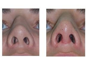 鼻甲肥大是不是就是腺样体肥大,鼻甲肥大是不是鼻头看起来比较大