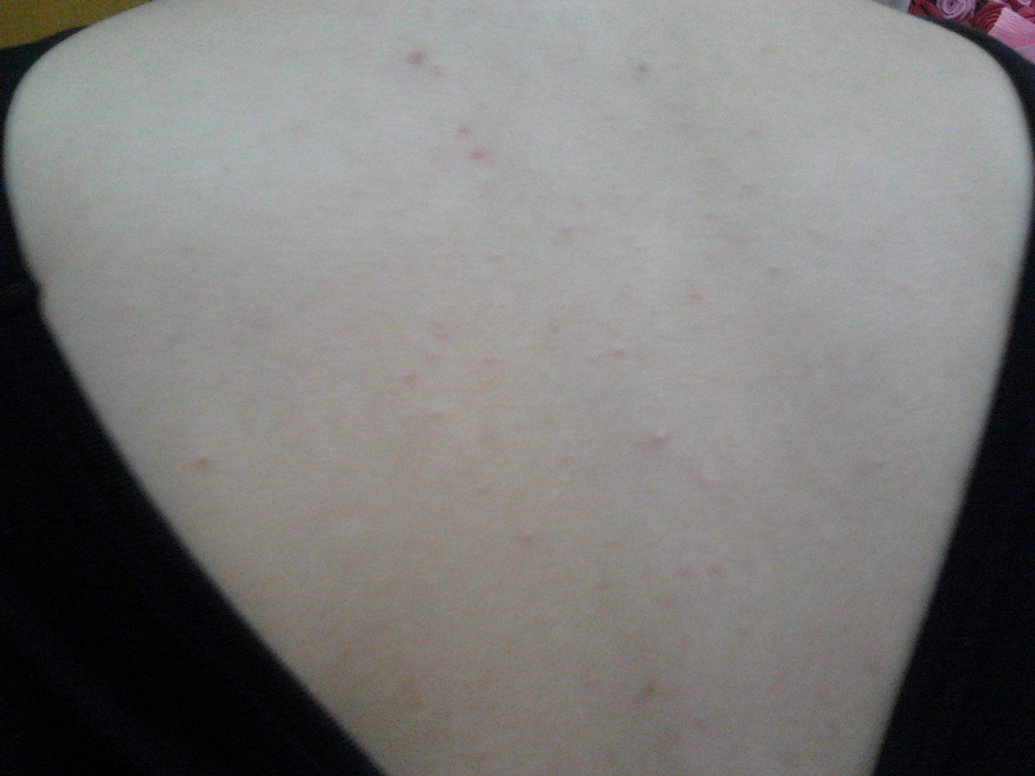 Freepure菲朴：背上长痘痘怎么办？7大杀招全解决