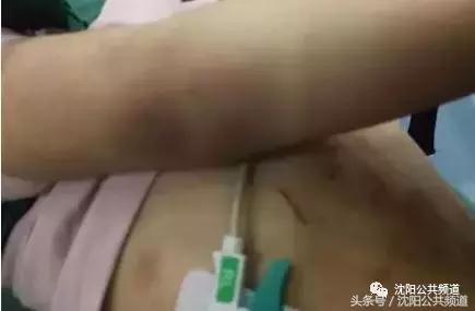 8岁孩子被成年人殴打颅内出血,男童被亲妈虐待致颅内出血