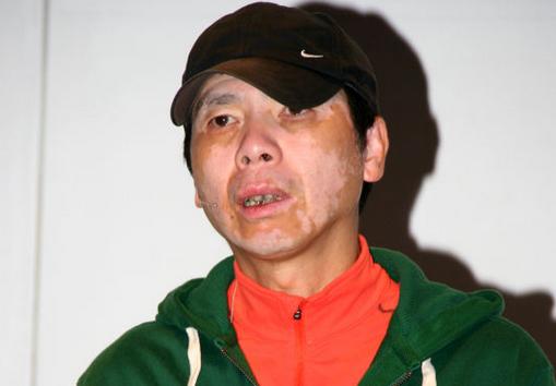 白癜风病人的问题,白癜风总有新的白斑出现怎么办