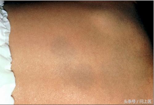 胎记原来是这样来的,你有胎记吗什么意思