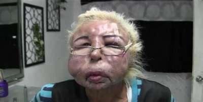 微整美容院骗局曝光,私人美容工作室做微整