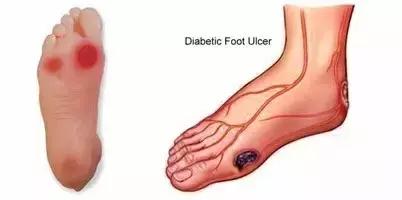 肥胖引起的血糖高怎么快速降下来,肥胖患者降血糖应该怎么做