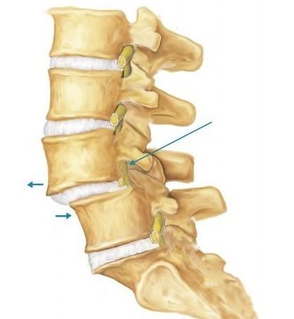 腰椎滑脱怎么锻炼康复呢,腰椎滑脱康复的正确锻炼方法