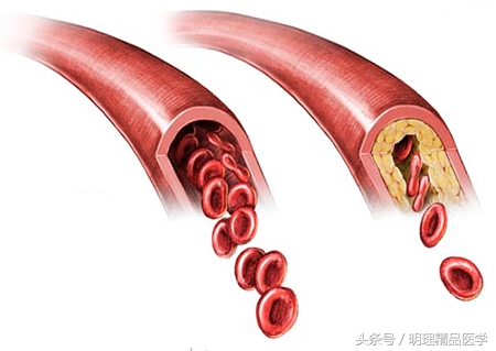 动脉硬化是无可避免的吗,动脉硬化是不可逆的吗