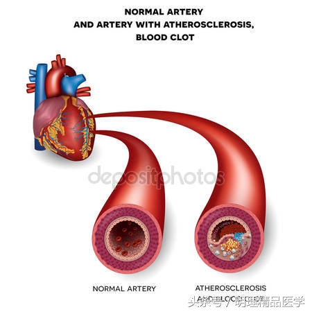 动脉硬化是无可避免的吗,动脉硬化是不可逆的吗
