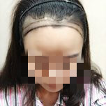 大额头适合用什么植发,大额头发际线高怎么办