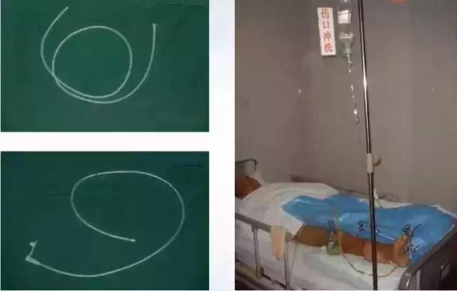 创面伤口感染如何处理,如何预防创面感染