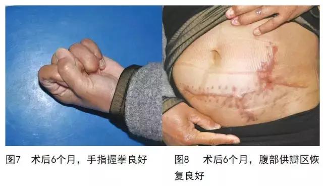 vsd负压引流加皮瓣移植,vsd植皮和皮瓣手术哪个损伤大