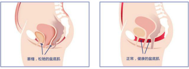 一笑就漏尿的偏方,尿失禁锻炼盆底肌的动作视频